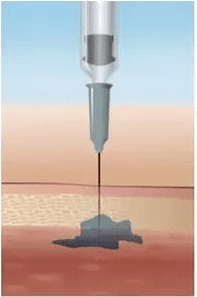 DERMOTECHNIKA - HYALURON PEN - daermes.com